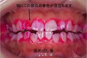 染め出し後の歯面を見てみると、赤く染められている部位を確認することができます