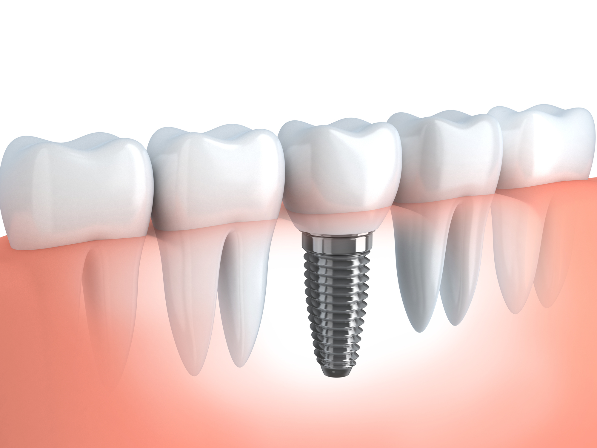 インプラントは歯を失ってしまった方への治療法です。